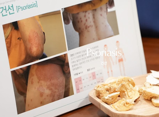 생기한의원으로 살펴보는 건선 증상 형태와 범위의 개인차